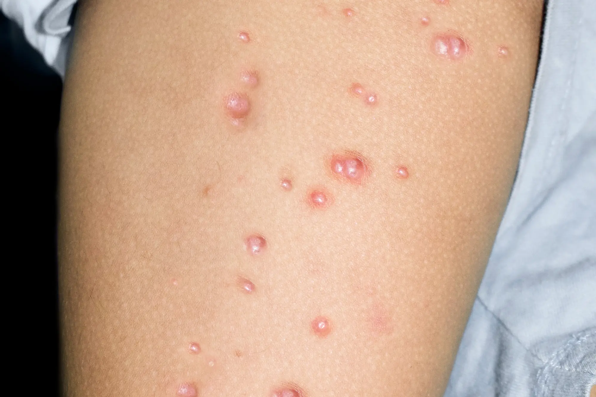 An example of Molluscum Contagiosum